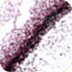 Oral Thrush (Oral Candidiasis)